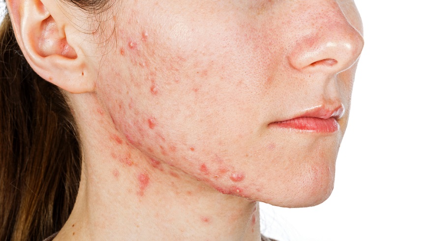 一旦停用「鴉片面膜」，皮膚會出現過敏、紅斑、丘疹等不適症狀。示意圖／TVBS