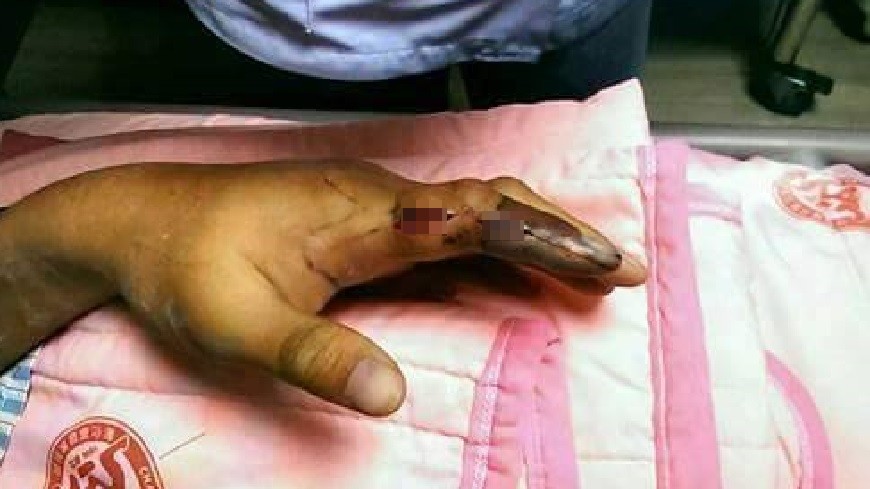 洪員左手指遭眼鏡蛇咬傷，組織壞死只能截肢。圖／截取自爆料公社臉書