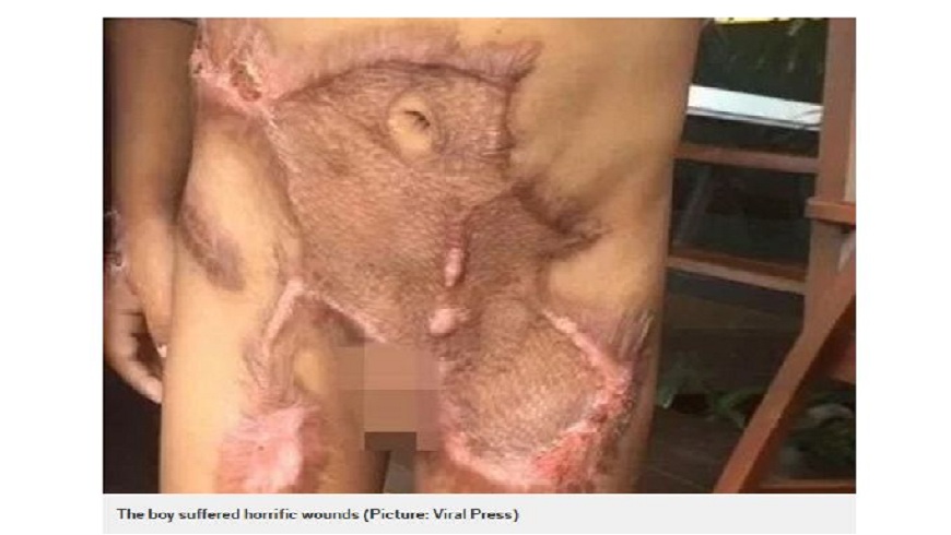 泰國一名5歲男童下體被保母夫婦用熱水潑傷，最後只能去勢保住一命。(圖／翻攝自都會報)