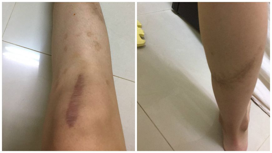 暖心女孩公開自己車禍後腿上留下的傷疤。圖/《Dcard》