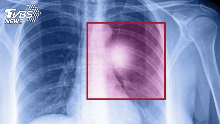 示意圖／TVBS 肺癌死亡率高　免疫療法成新選項