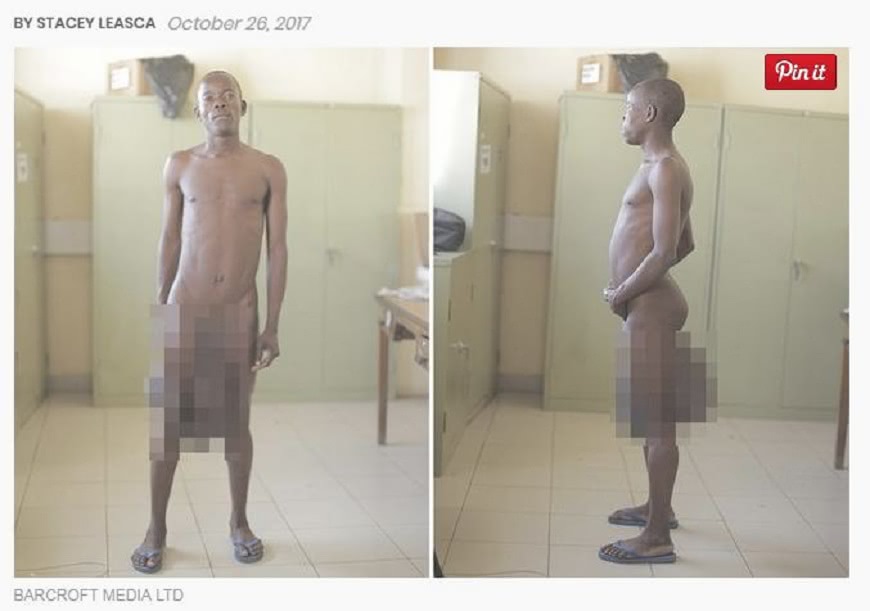 肯亞一名男子因被蚊子叮咬陰莖，結果長成了91公分的巨雕。(圖／翻攝自男人的健康)