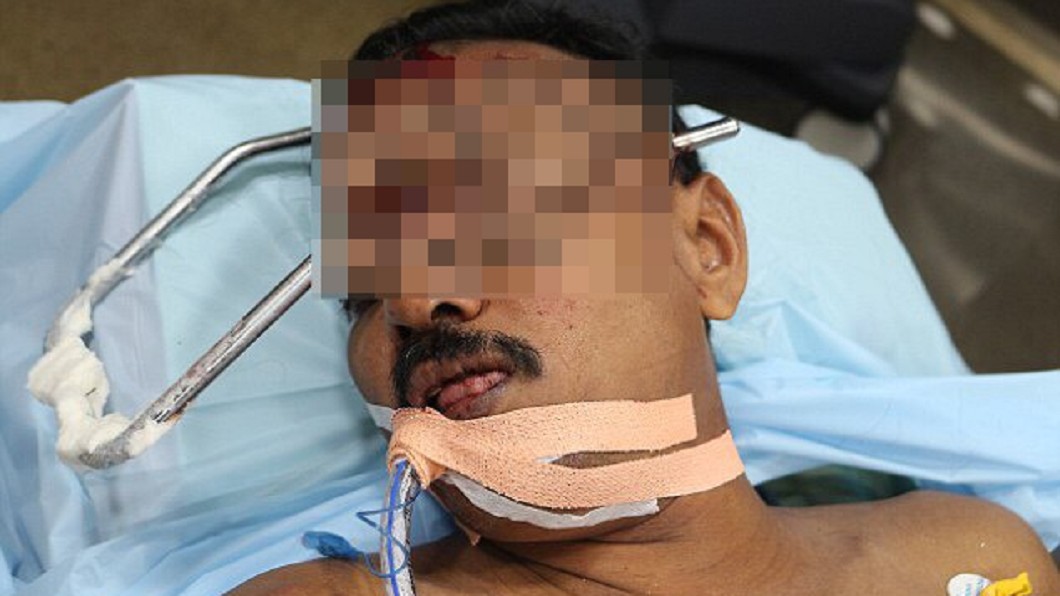 印度南遇嚴重車禍，座椅鐵條貫穿頭顱。圖／翻攝自 每日郵報