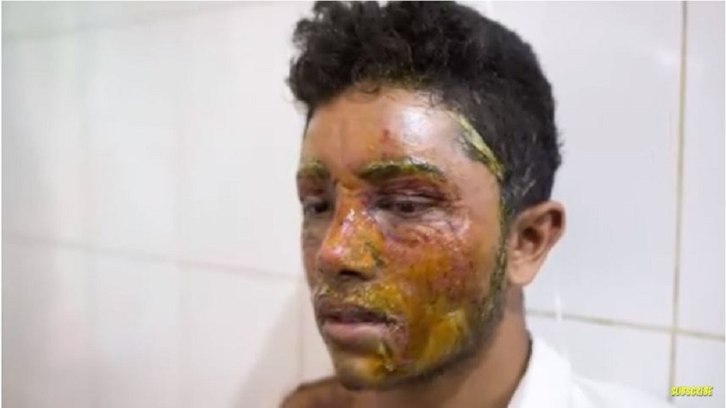孟加拉一名男子因拒絕少女求愛而遭對方潑酸毀容，該案例在當地非常罕見。(圖／翻攝自YouTube)