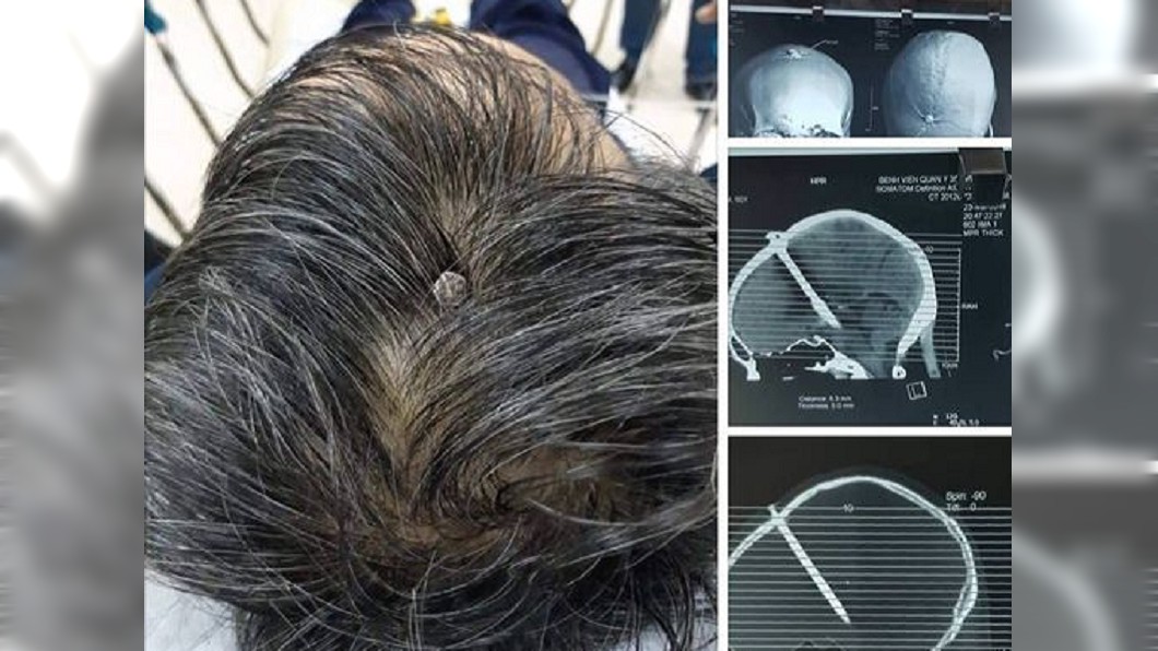 男子的頭頂被插入一根釘子，他痛了2天才去檢查。(圖／翻攝自Reddit)