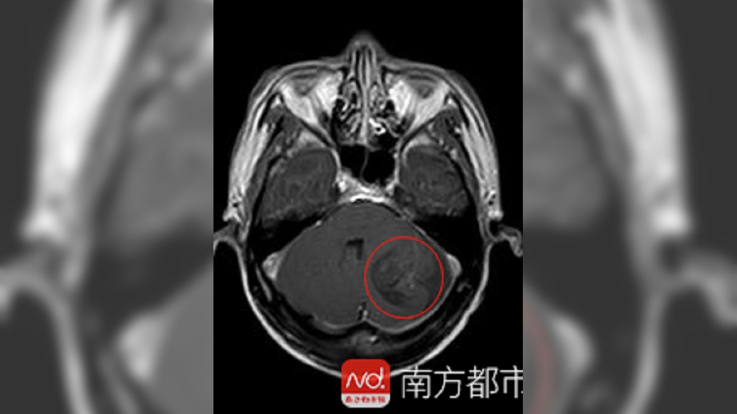 劉男吃半生豬肉,腦袋裡長滿蟲。圖/翻攝自大陸網易