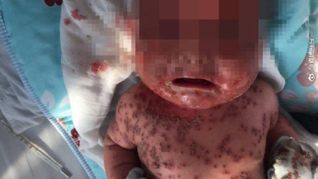 3個月大的女嬰全身長滿疱疹，緊急送醫。圖／翻攝自微博 可怕！女嬰全身長滿皰疹　全因家長「愛的親親」