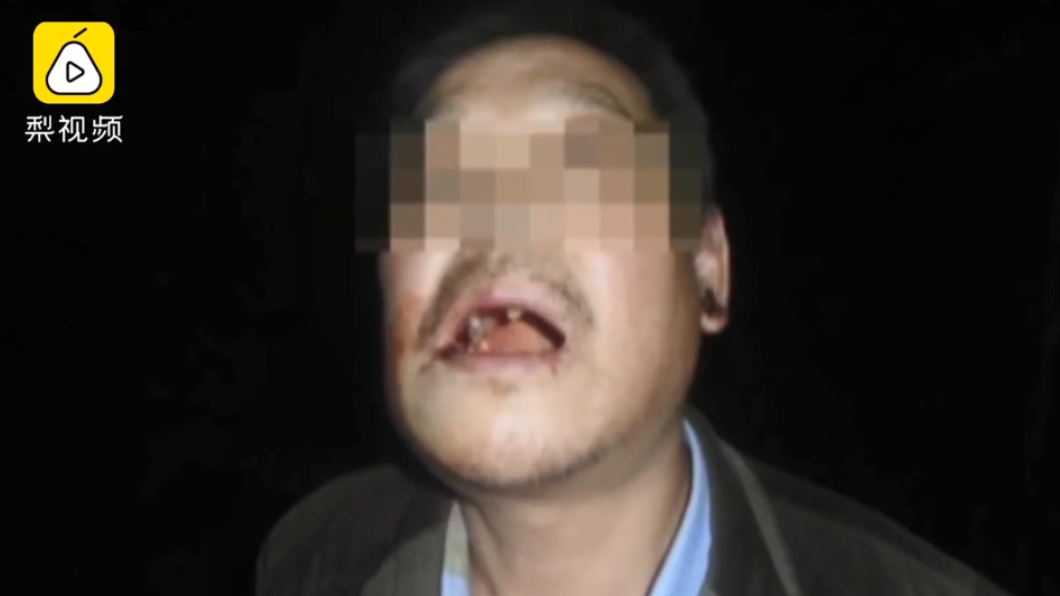 徐男口腔內有16顆牙齒脫落和碎裂。圖/翻攝自微博