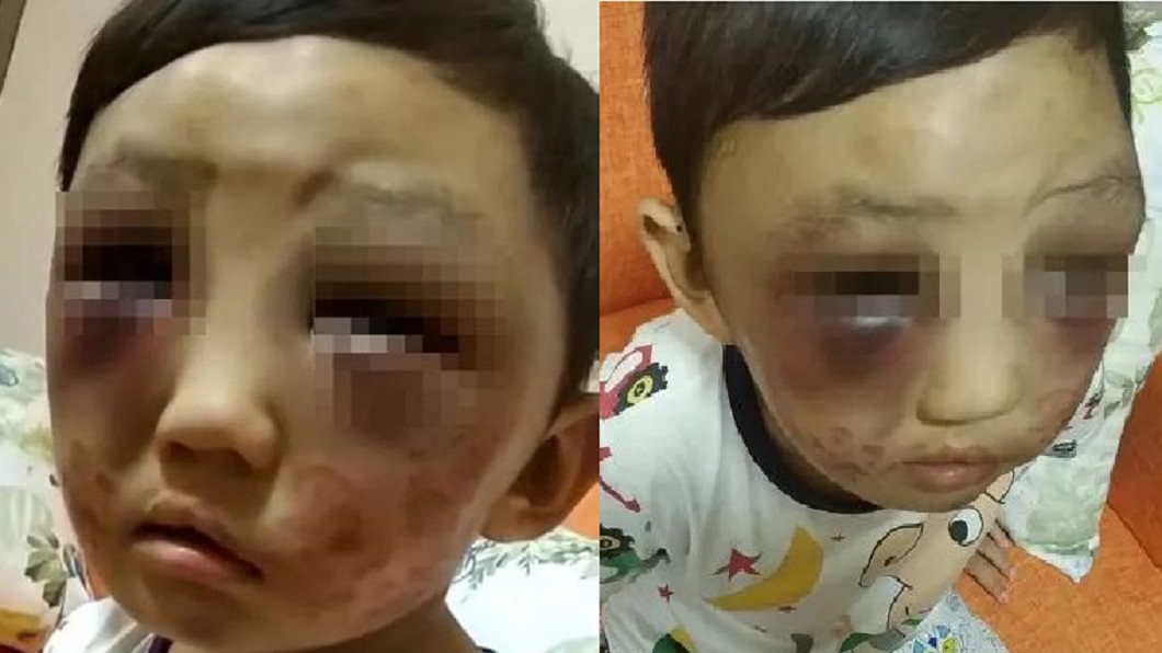 圖／翻攝自　廣州日報 4歲童遭毒打「雙眼瘀青」　狠母嗆：打小孩天經地義
