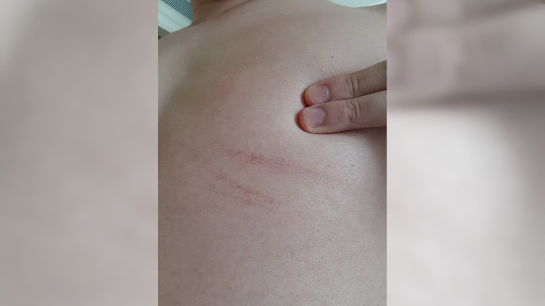 王樹偉還提到,自己隔天醒來後,卻發現胸下有抓痕。(圖/翻攝自「Dr. 王樹偉 Tree」臉書粉絲團)