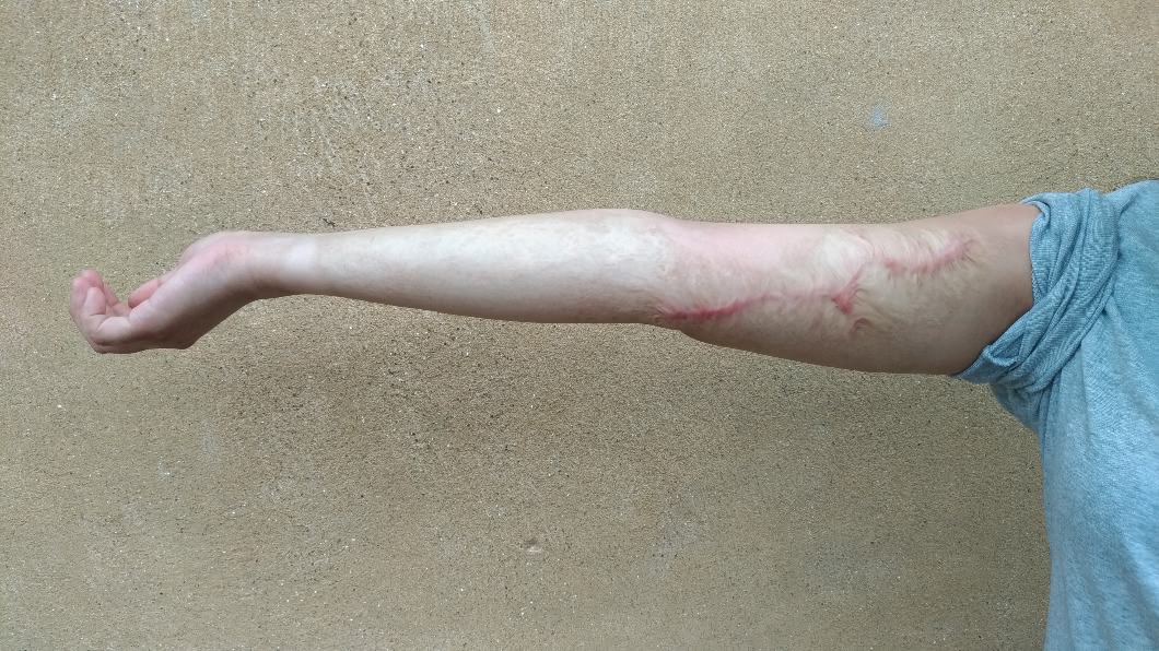 3年治療,蒂蒂皮膚仍是滿佈燒傷紋路,但已比先前平整。圖/蒂蒂提供