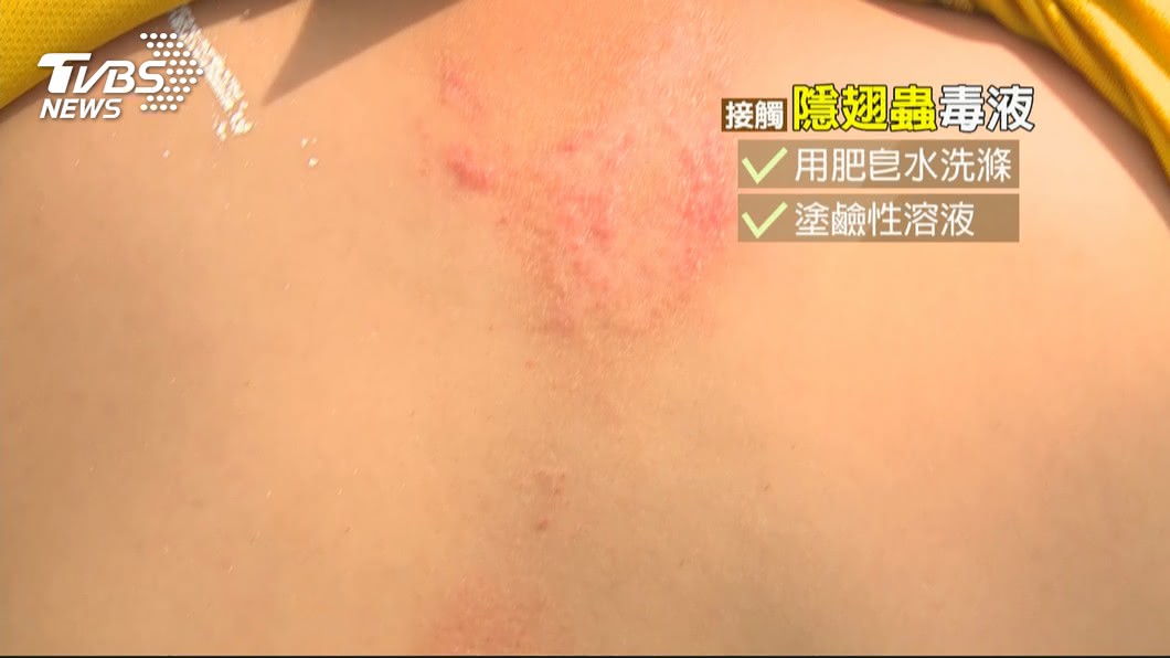 圖/TVBS 雨後隱翅蟲出沒 皮膚潰爛求診患者增2成