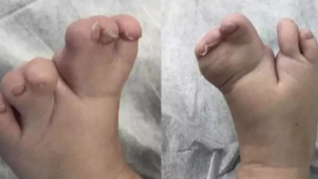 男嬰糖糖出生有多指狀況，左右腳有3指並指。圖／翻攝自 酷網