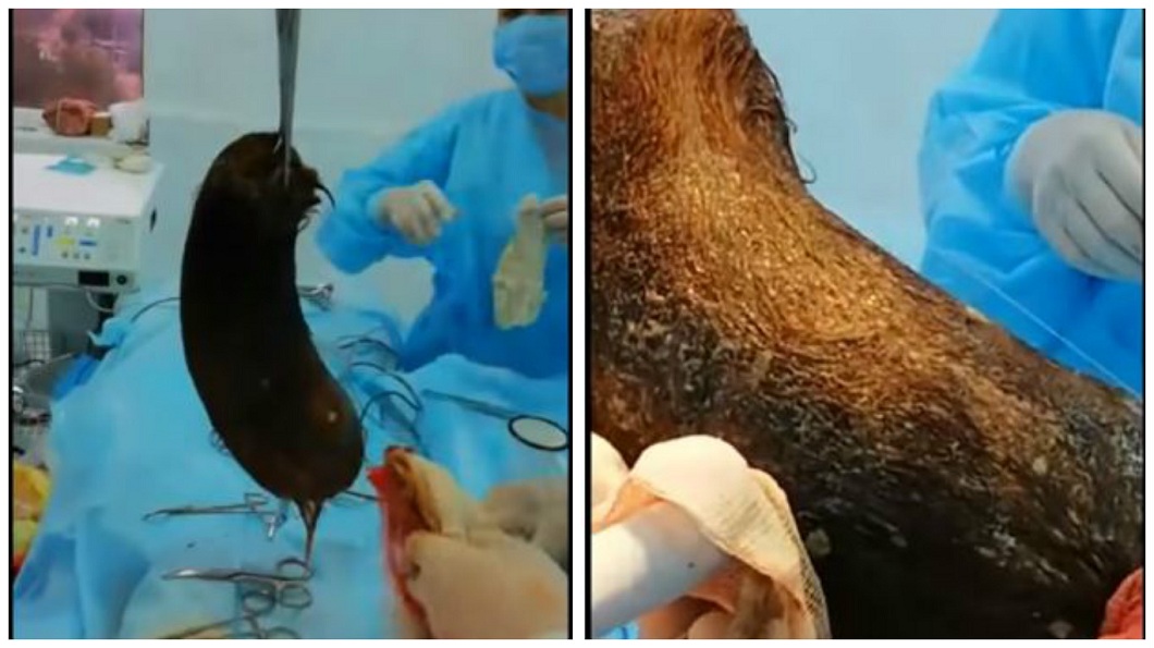 哈薩克一名女童吞了3.5公斤的毛髮，導致她食不下嚥。(圖／翻攝自YouTube)