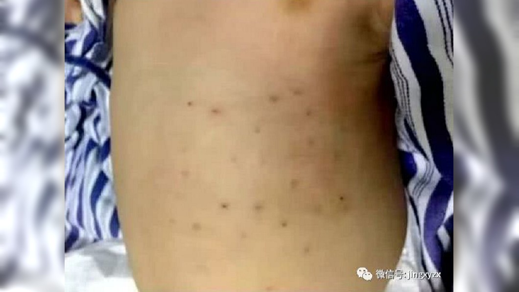 湖北襄陽一名出生不到2個月的男童，被父母親用碎玻璃刺他肚皮和背部的皮膚，讓人看了於心不忍。(圖／翻攝自湖北日報微博)
