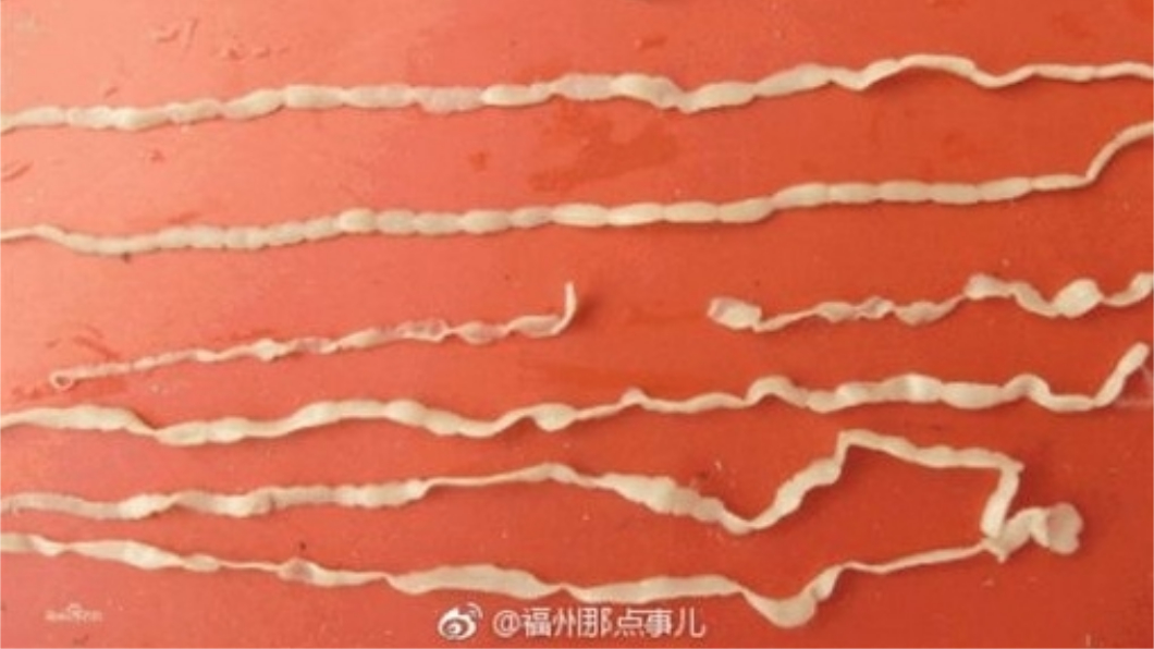 女子愛吃生魚片,結果拉出7.2公尺的絛蟲。圖/翻攝自微博