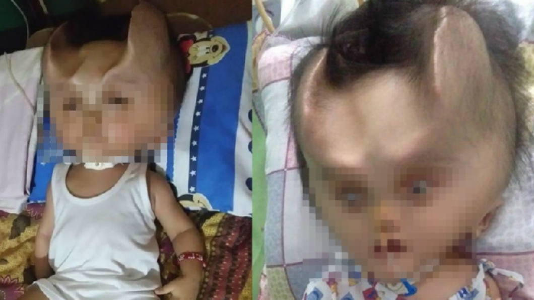 翻攝／Daily Star 菲國男嬰罹罕病　術後頭部竟長出「惡魔之角」！