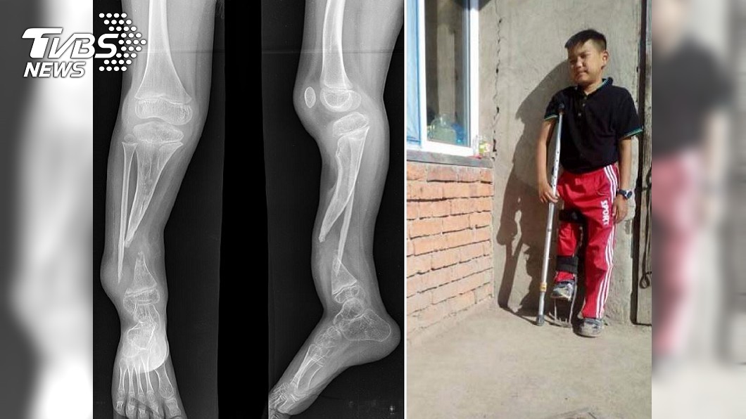 因為歷經4次手術失敗，阿莫的右腳比左腳少了15公分，平時上下學都需要爸爸陪伴，靠特殊拐杖緩慢行走。(圖／三軍總醫院提供)