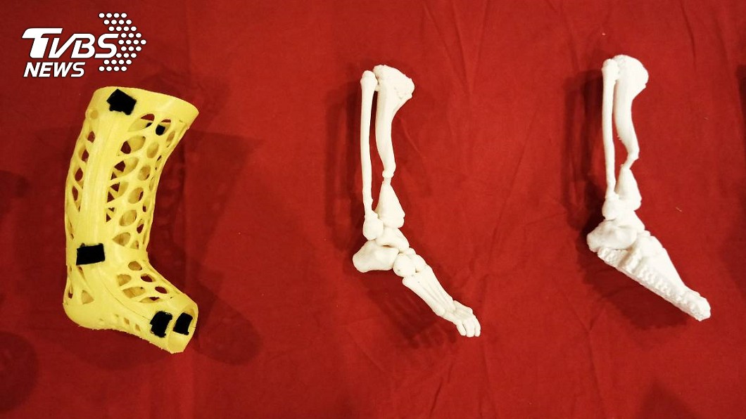三總團隊結合3D技術,列印出阿莫的1:1骨頭模型(右、中);左為可拆卸式石膏,可隨時查看骨頭癒合情形。(圖/TVBS)