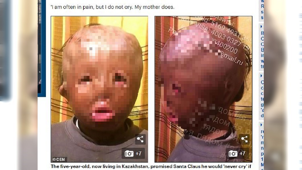 圖／翻攝自Daily Mail網站 5歲童遭火吻「臉部全融」　許下聖誕願望引淚崩
