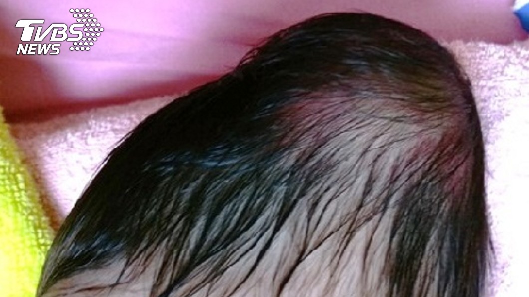 圖／中國附醫提供 新生兒頭皮血腫別亂揉　8天大嬰「染菌」癱瘓