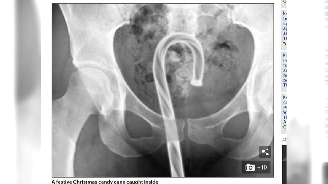 X光片竟拍出病人直腸內出現拐杖糖。圖／翻攝自每日郵報