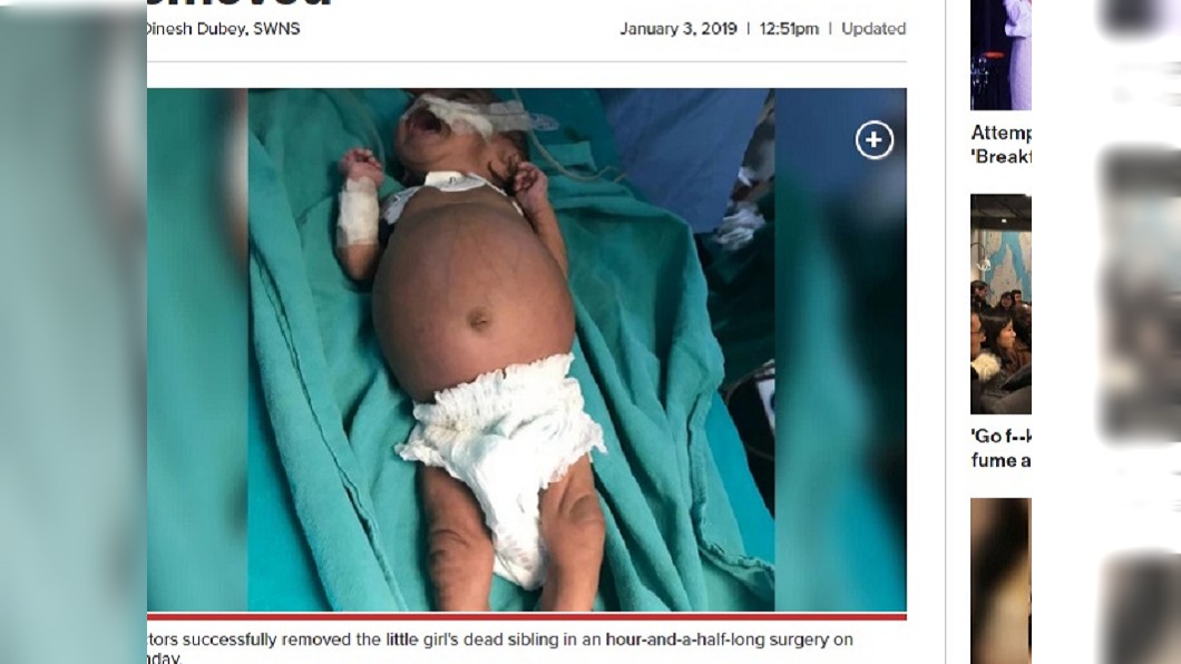印度一名孕婦去年產下一名女嬰，但孩子的腹部卻異常腫大。圖／翻攝自NEW YORK POST