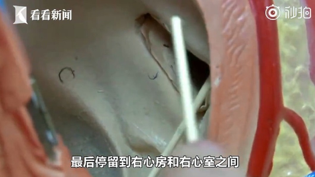 醫師提到,這根牙籤剛剛好插在右心房和右心室之間,所幸並未造成心臟破裂。圖/翻攝自《微博》