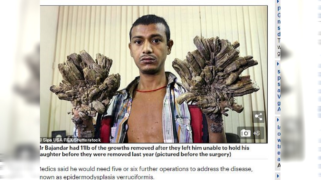 孟加拉男子罹患怪病，手腳長出的肉疣宛如樹皮一般。圖／每日郵報