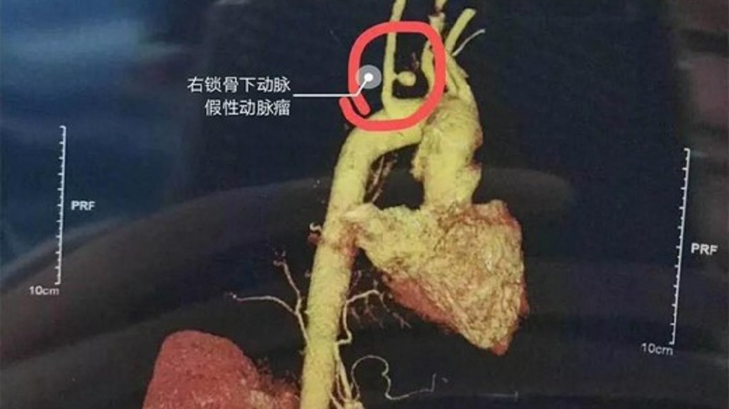 婦人誤吞魚刺吐血險喪命。圖/翻攝微博