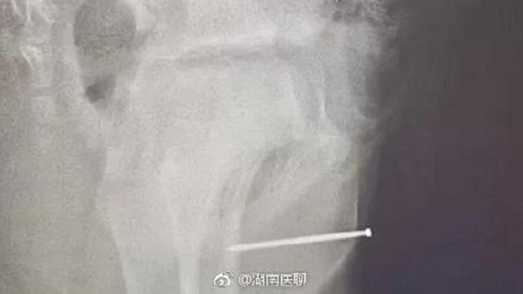 圖/翻攝自湖南醫聊微博