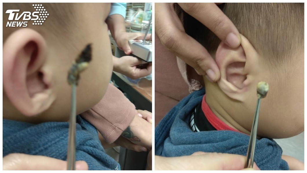 男童的右耳一共挖出2坨超大耳屎。(圖／門諾醫院提供)