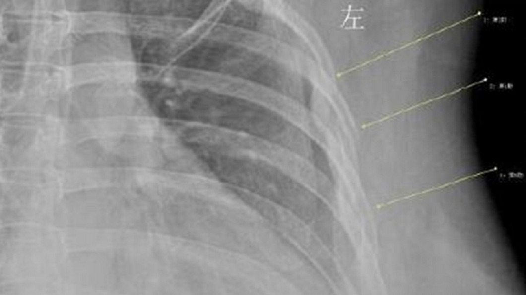 大陸武漢這名OL因咳嗽胸痛,就醫檢查後發現,肋骨竟斷了3根。圖/翻攝自微博