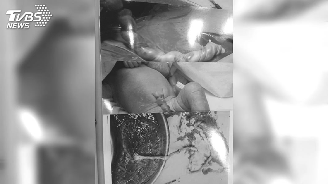 朱媽媽當時剖腹生產,被告知女兒有臍帶扭轉問題,再慢幾天恐怕沒命。圖/朱媽媽 授權提供