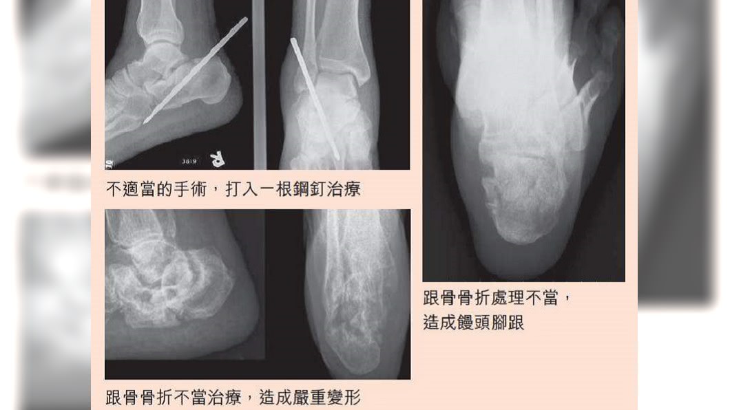 足踝外科名醫 依勞保規定跛腳竟不如少根腳趾 關節 骨折 跟骨 Tvbs新聞網