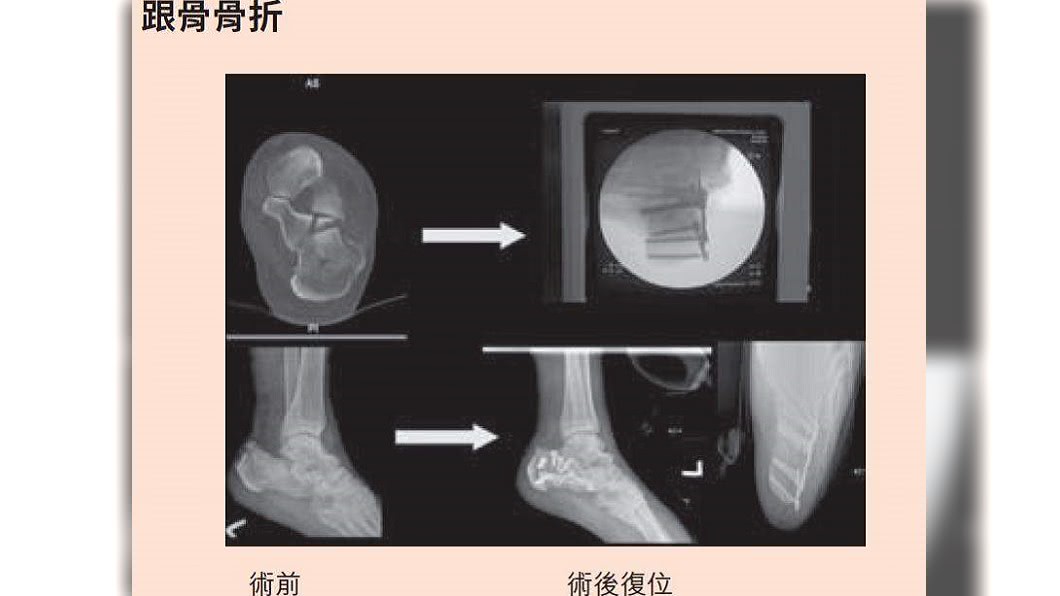 (圖/《自己的腳痛自己救》;時報出版提供)