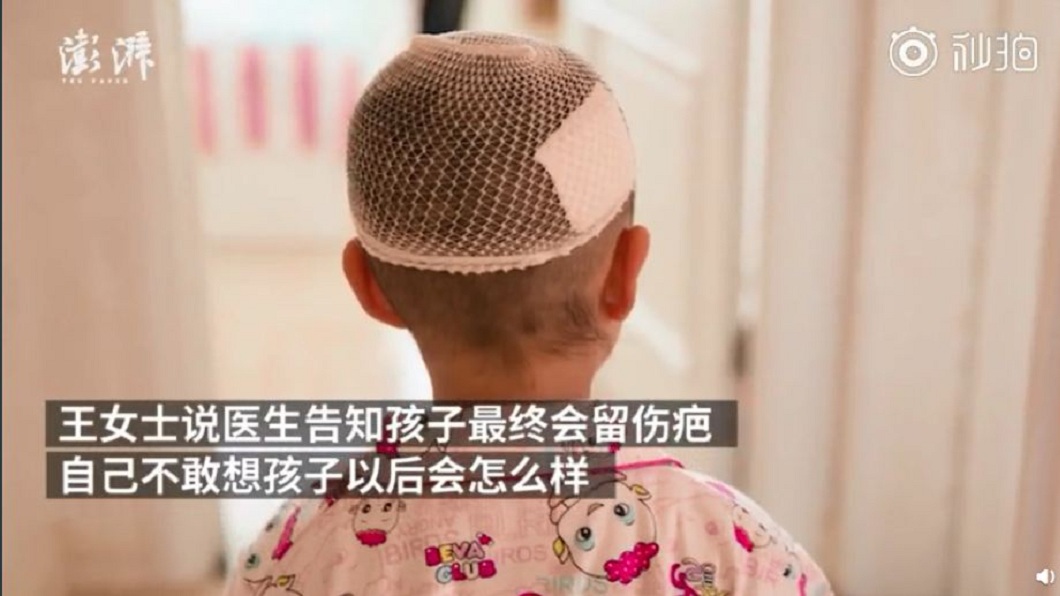 女童雖然保住一命,但未來恐面臨多次的整容手術。(圖/翻攝自微博)