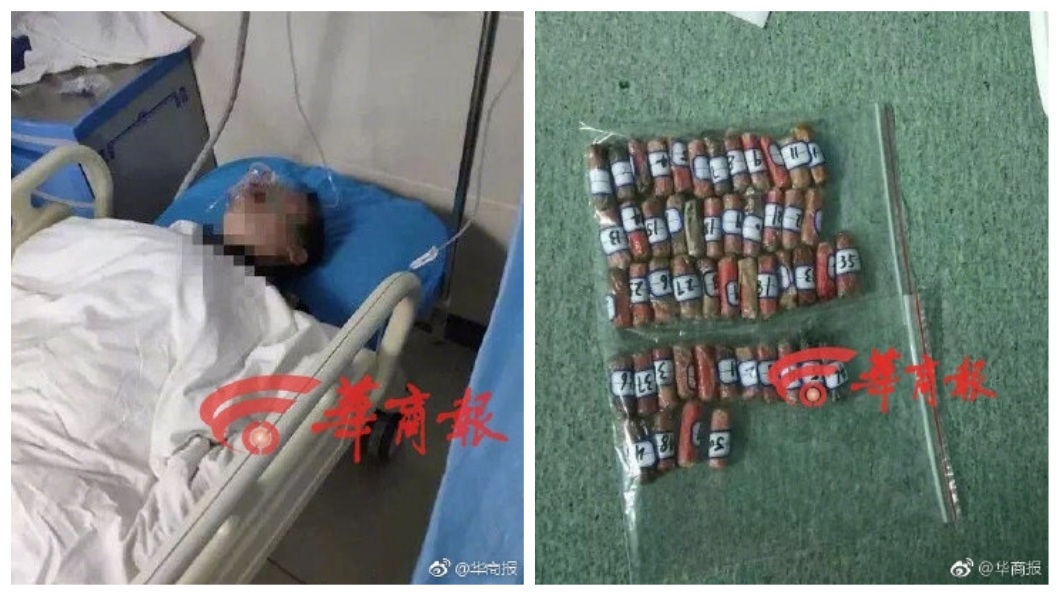 事後醫師從孕婦體內取出59包海洛英,所幸經過急救已無生命危險。(圖/翻攝自華商報微博)