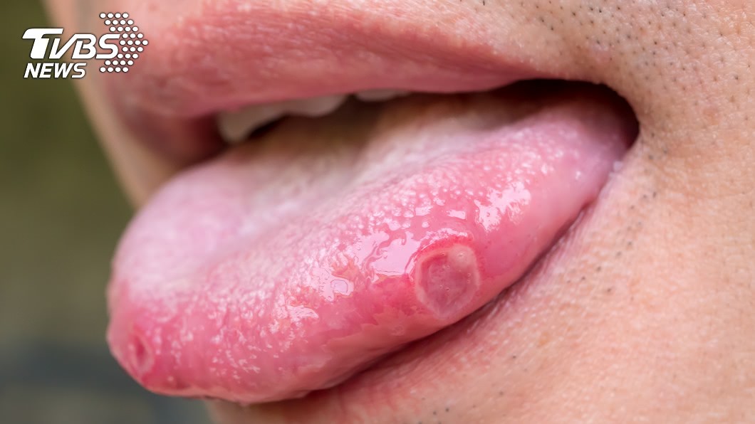 老翁舌頭破洞還感染長膿包，都是壞習慣害的。舌頭破洞示意圖／TVBS