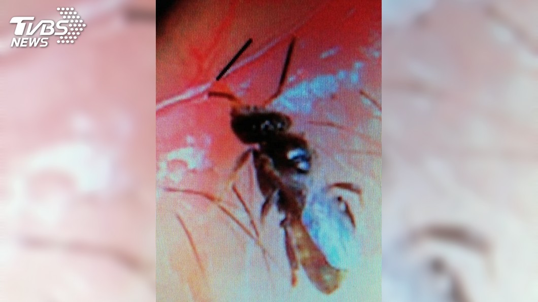 一名女子日前去掃墓後眼睛突然腫脹,發現裡面竟飛進4隻汗蜂。(圖/TVBS)