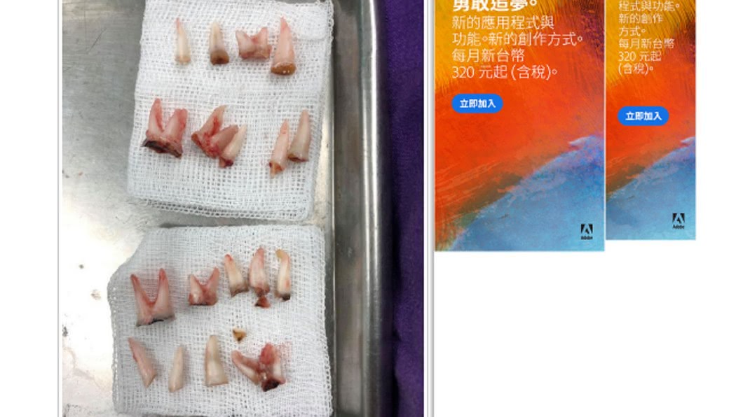 乳牙被蛀光無法填補,只能拔掉。圖/翻攝自中國網