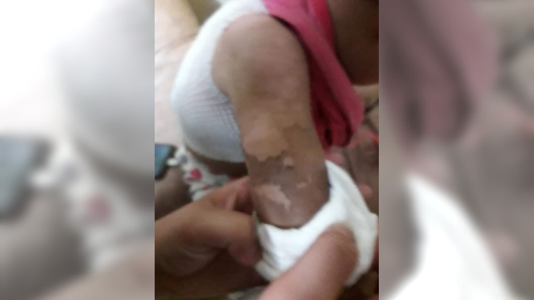 女童遭父親用熱水燙傷，皮膚多處脫皮。圖／翻攝自臉書