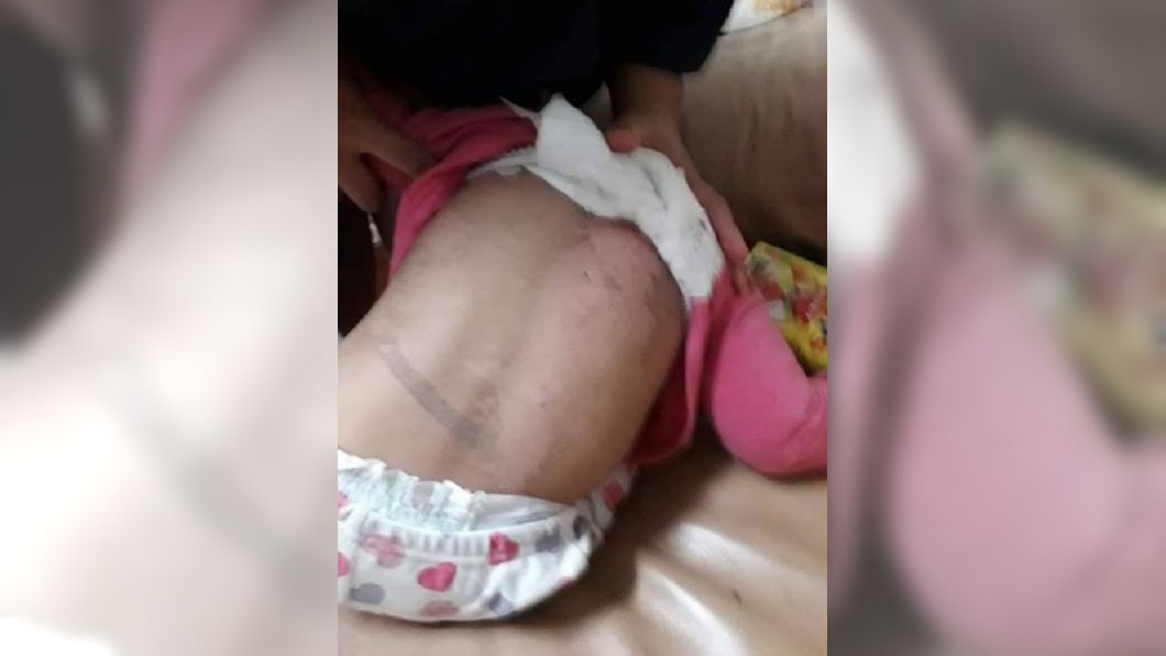 女童背部多處脫皮。圖/翻攝自臉書