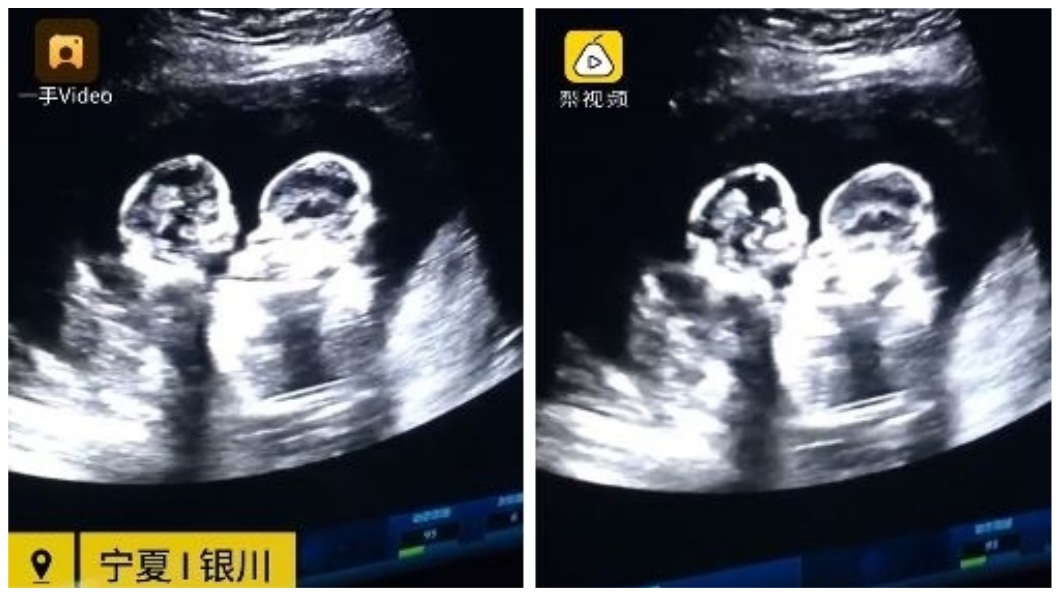 寧夏一名母親在懷孕3個月時去醫院照超音波產檢,意外發現肚子內的雙胞胎女兒竟然在打架。(圖/翻攝自梨視頻)