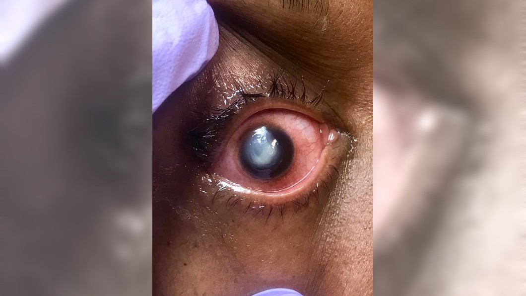有患者戴隱眼睡覺,導致眼球發白。圖/翻攝自Vita Eye Clinic臉書