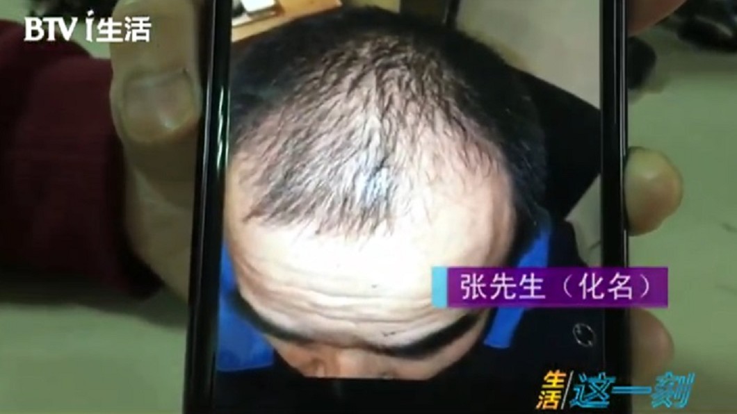 張男表示,買了生髮產品後,用了5個月,頭髮反而掉更兇。圖/翻攝自微博