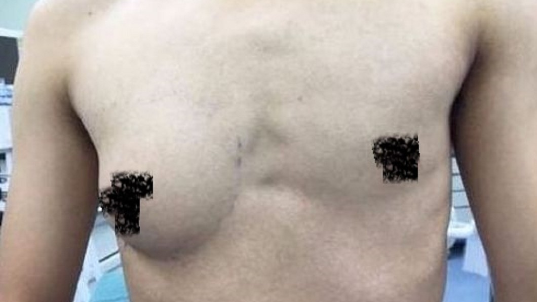 他只有「右側乳房」發育的像女性一樣。圖/翻攝自微博