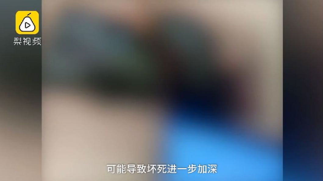 醫師表示女子如果再晚一步,恐會面臨截肢甚至嚴重感染。(圖/翻攝自梨視頻)