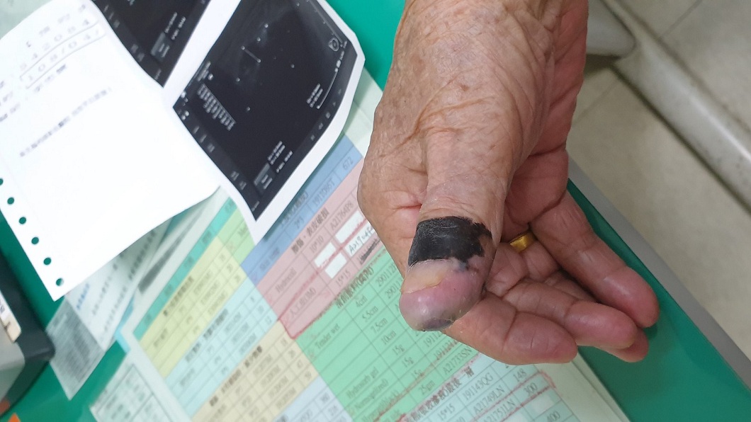 阿嬤日前洗澡是發現腋下有硬塊,檢查之後發現竟是因為右手拇指的黑痣所引起。(圖/翻攝自「彰化人彰化事」臉書粉絲團)