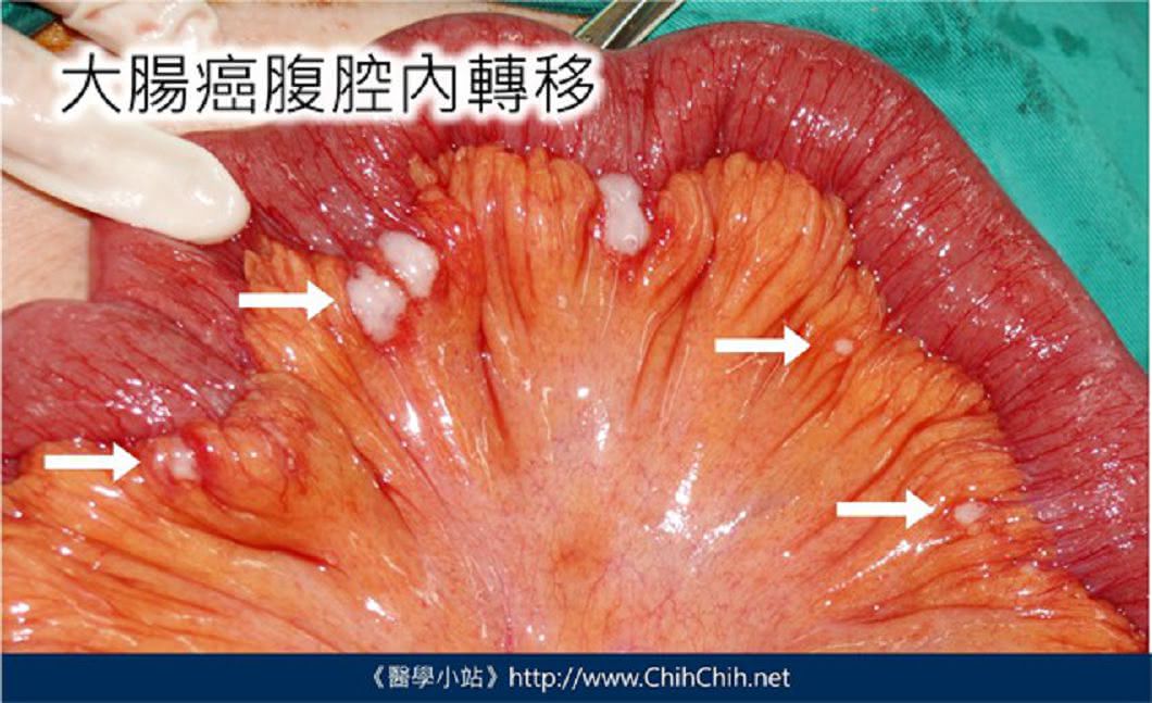 圖/翻攝Care照護線上